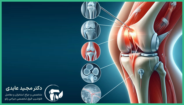 جراحی ترمیم مجدد رباط صلیبی چه زمانی ضروری است؟