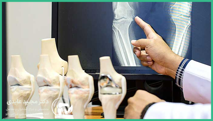 عوامل تاثیر گذار در هزینه جراحی رباط صلیبی
