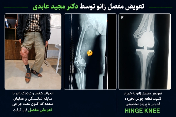 یک نمونه جراحی تعویض مفصل زانو