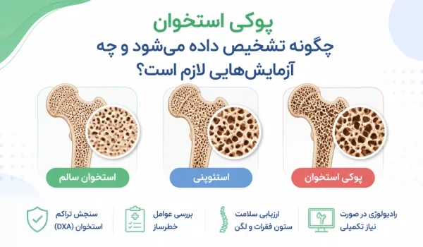 پوکی استخوان چگونه تشخیص داده میشود و چه آزمایشهایی لازم است — مقایسه ساختار استخوان سالم با استئوپنی و پوکی استخوان